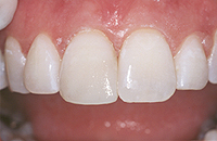 The dental bonding done on the chipped tooth is impossible to distinguish with the naked eye.