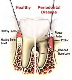 Gum disease hard to detect without a professional exam.