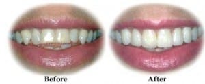 Before and after images demonstrating results that are possible with porcelain veneers.