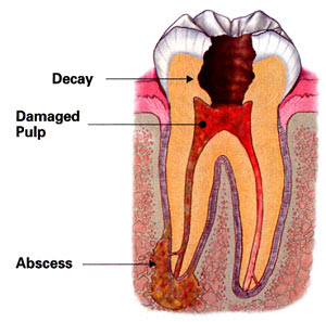 Dr. Hadgis of Grosse Pointe Woods offers root canal treatment.