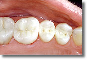 The same teeth, after replacing the amalgam fillings with composite white fillings