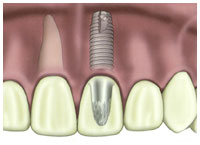 Diagram of dental implant root form with crown