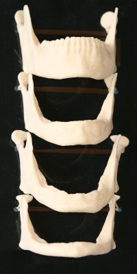 This graphic illustrates the gradual deterioration of jaw bones that lead to facial collapse.