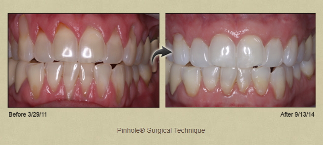 Before and after photos of pinhole surgical technique