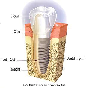 diagram of a dental implant