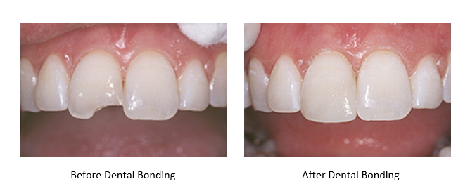 before and after dental bonding