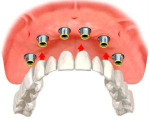 implant supported dentures