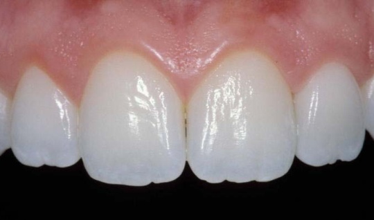 beautifully veneers teeth