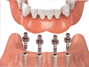 Implant overdentures