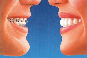 Illustrated comparison of conventional braces and Invisalign clear aligner